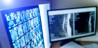 Researchers From NVIDIA & Vanderbilt University Propose ‘Swin UNETR’: A Novel Architecture for Semantic Segmentation of Brain Tumors Using Multi-Modal MRI Images