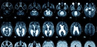 NVIDIA’s Cambridge-1 Supercomputer And MONAI Were Utilized By Researchers At King’s College London To Develop Open-Source Synthetic Brain Pictures, Which Will Help To Speed Up AI In Healthcare