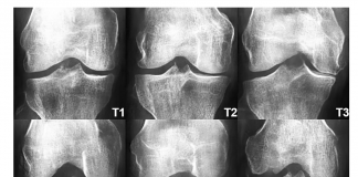 Latest Artificial Intelligence Research Presents Generative Adversarial Neural Networks Capable of Generating DeepFake Knee Osteoarthritis X-rays with Varying Osteoarthritis Severity