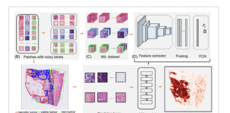 Researchers from Johns Hopkins Medicine Developed a Machine Learning Model for Precise Osteosarcoma Necrosis Calculation